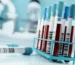 Laboratory blood sample tubes used in research on predicting lung cancer risk years before diagnosis.